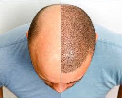 Understanding Hair Transplant: A Solution to Hair Loss